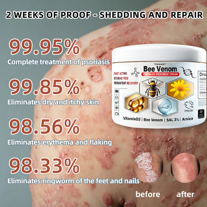 🌿TODAHOF™ Bee Venom Psoriasis Multi-Symptom Treatment Cream (👨‍⚕NPF RECOMMENDS)